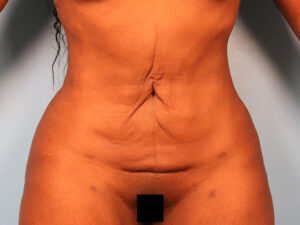 Case--30599 | Before Tummy Tuck (Abdominoplasty) 1