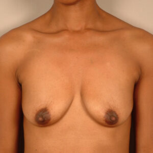 Case--9115 | Before Augmentation Mastopexy 1