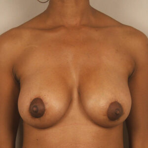 Case--9115 | After Augmentation Mastopexy 1