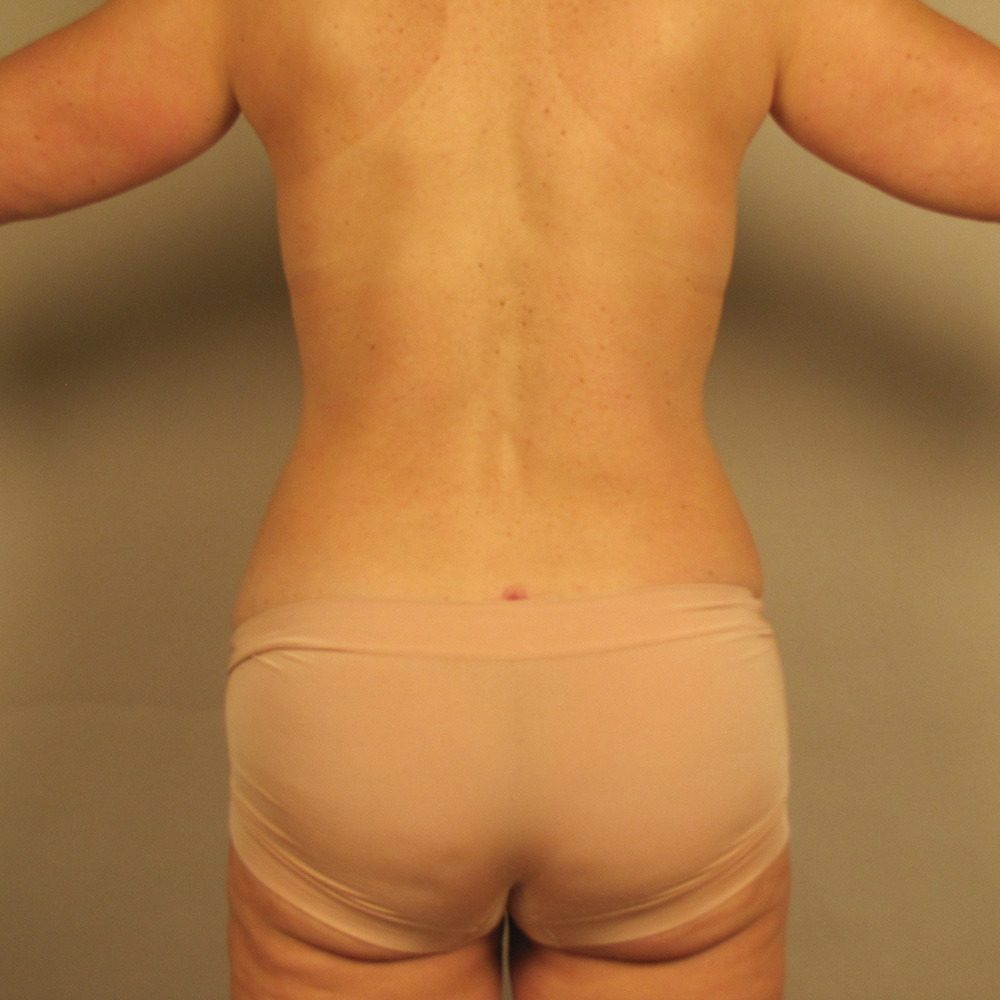 Case--4355 | After Liposuction