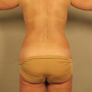 Case--4355 | Before Body 1