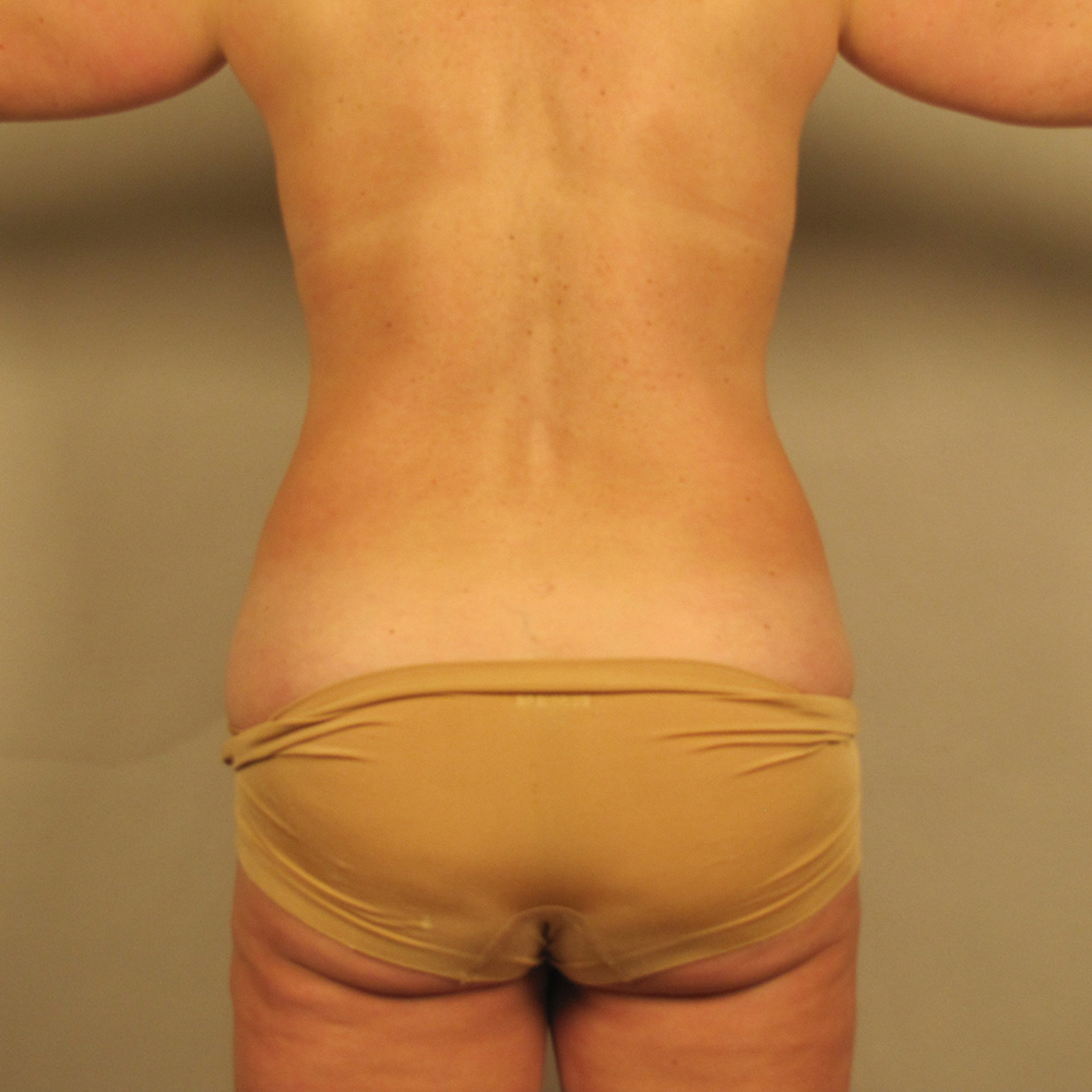 Case--4355 | Before Liposuction