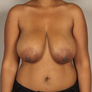 Case--2412 | Before Bilateral Reduction Mammaplasty (Breast Reduction) 1