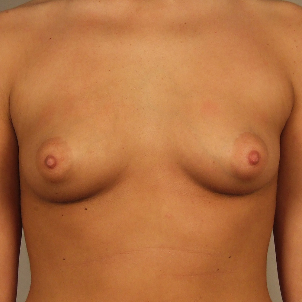 Case--8428 | Before Breast Augmentation