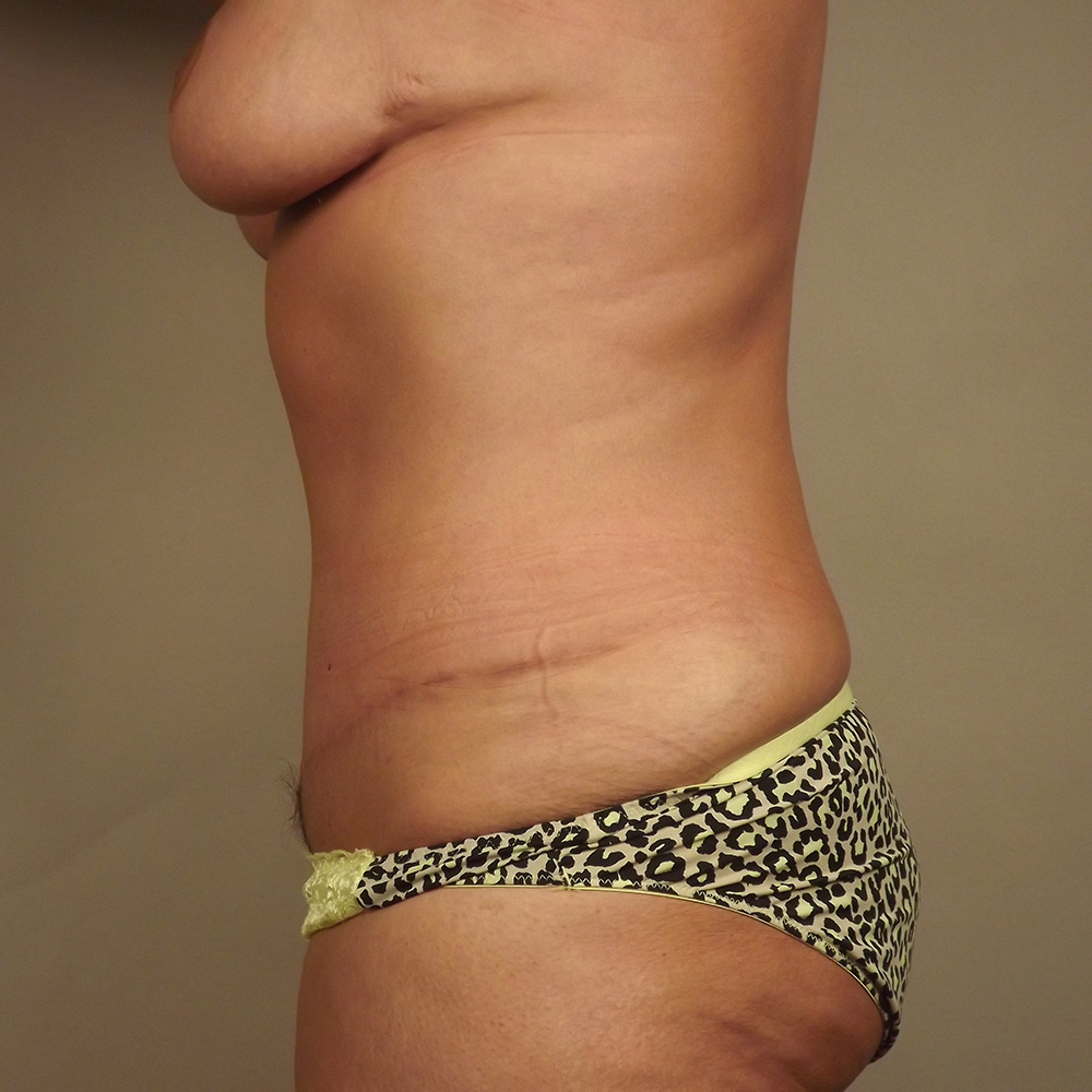 Case--4002 | After Abdominoplasty 2