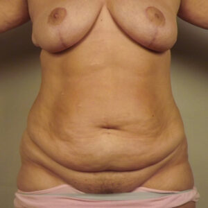 Case--4002 | Before Abdominoplasty 1