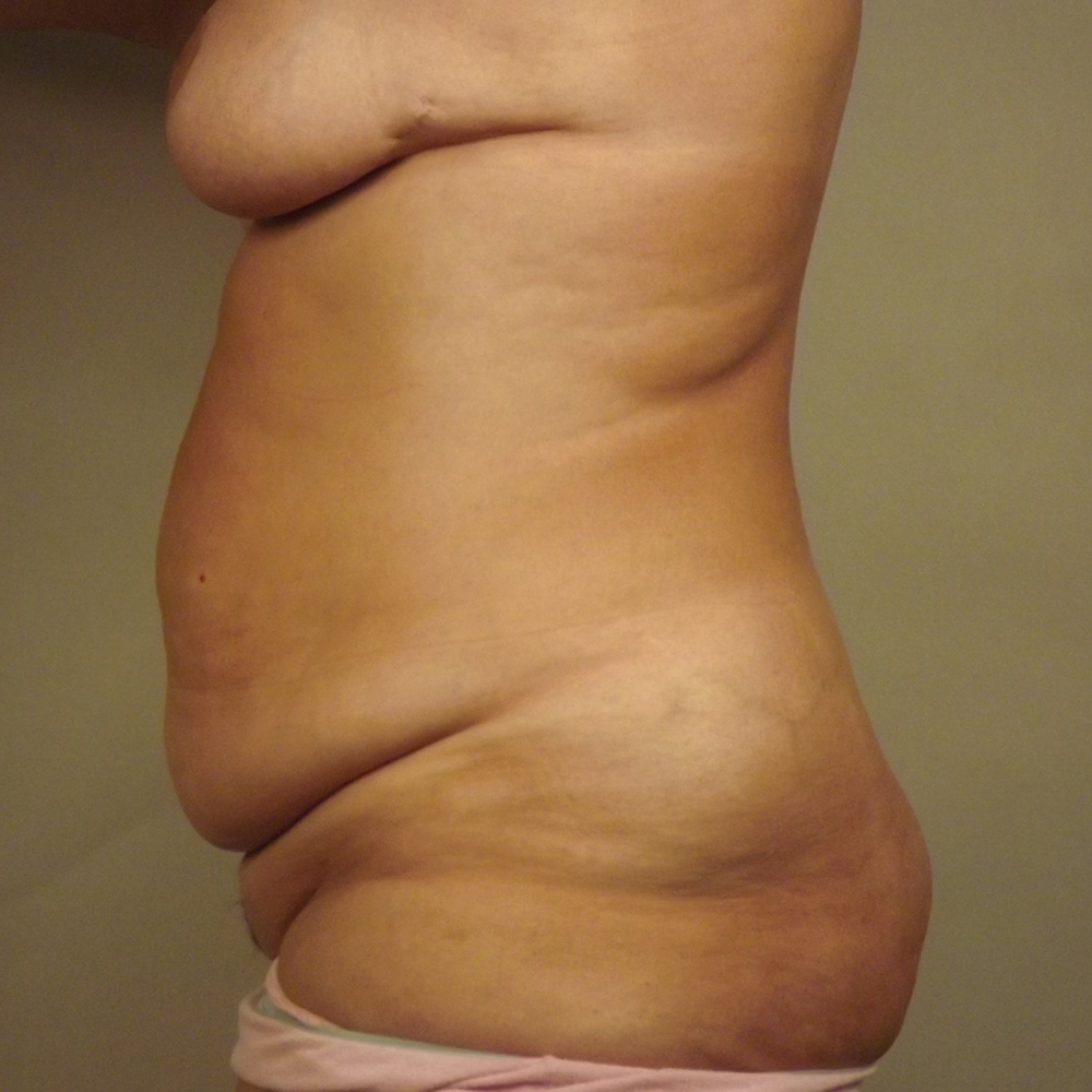 Case--4002 | Before Abdominoplasty 2
