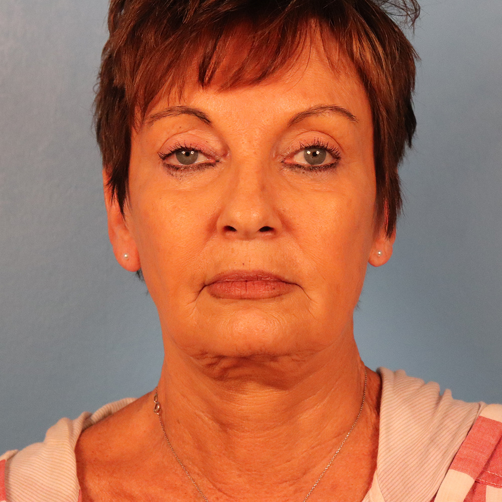 Case--5288 | Before Facelift