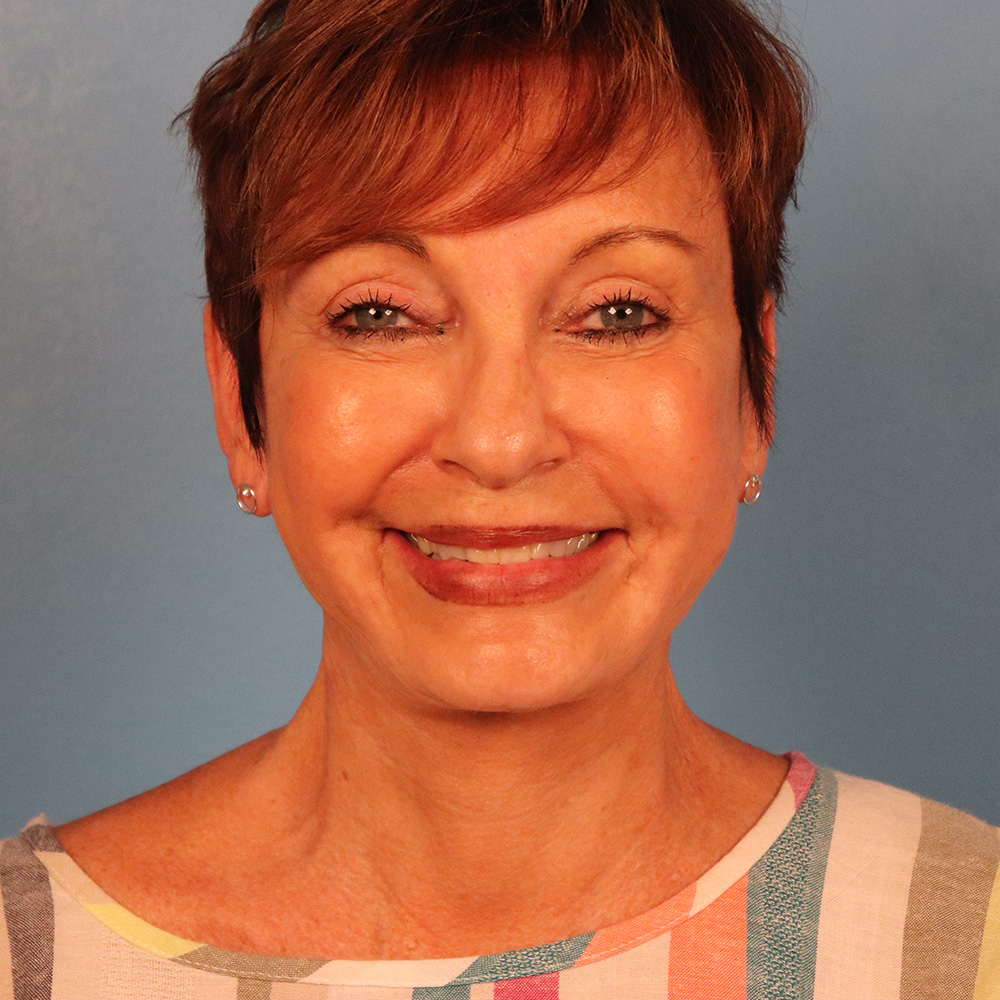 Case--5288 | After Facelift