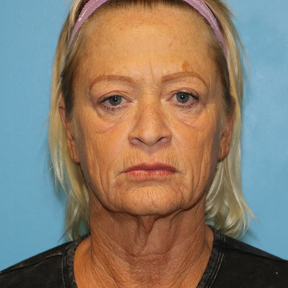 Case--6858 | Before Facelift