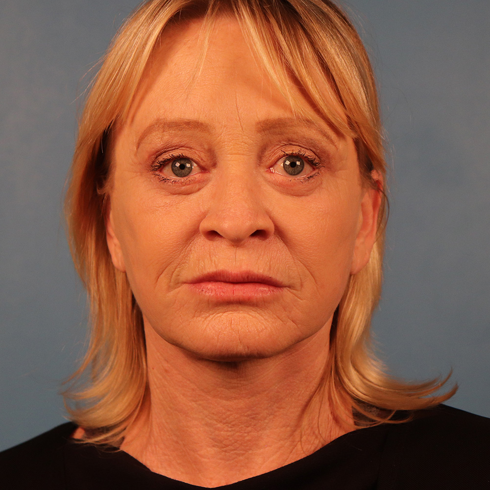 Case--6858 | After Facelift