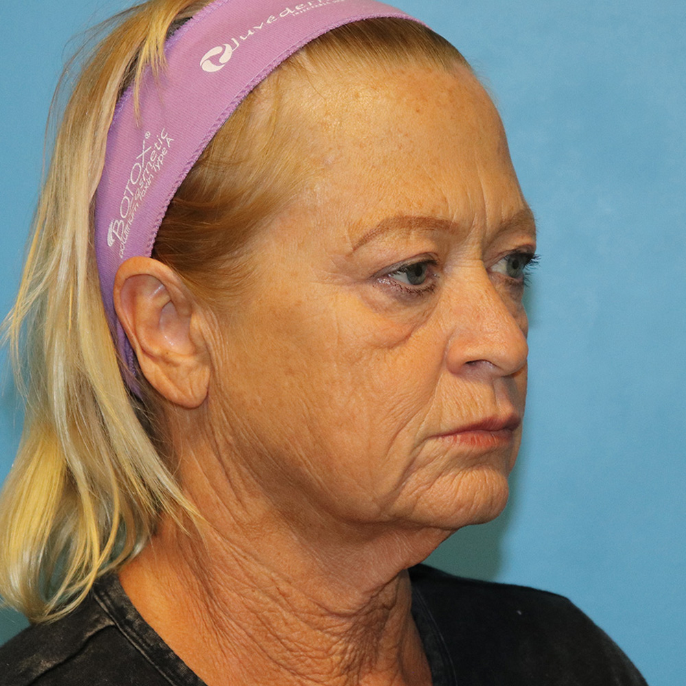 Case--6858 | Before Facelift 2