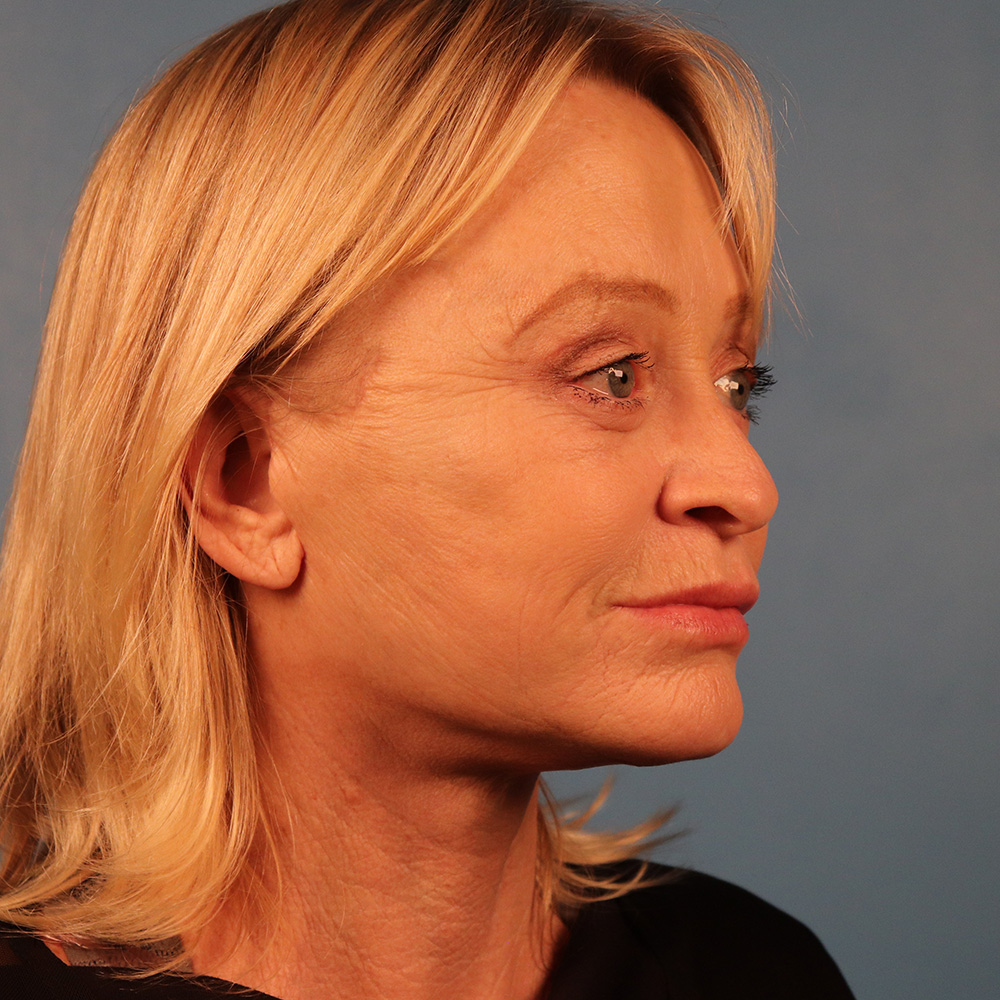 Case--6858 | After Facelift 2