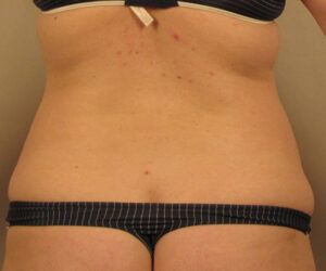 Case--4798 | Before Body 1
