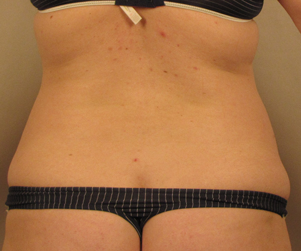 Case--4798 | Before Liposuction