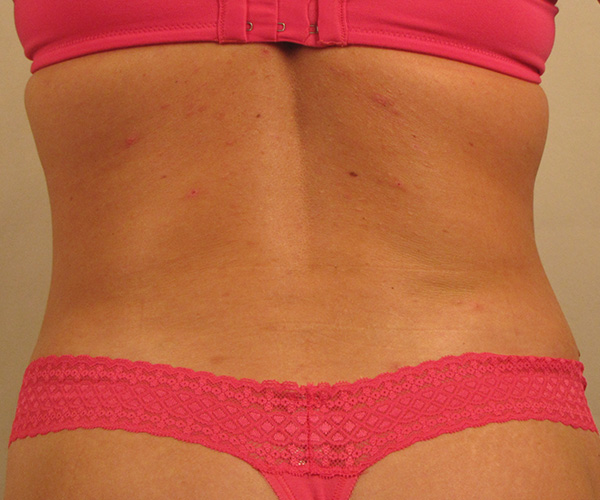 Case--4798 | After Liposuction