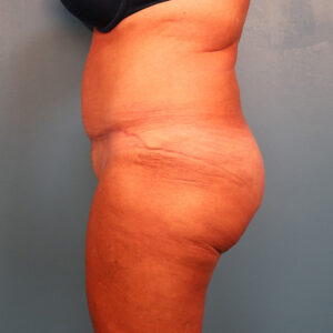 Case--36352 | After Tummy Tuck (Abdominoplasty) 2