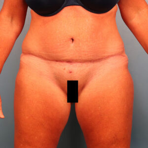 Case--36352 | After Tummy Tuck (Abdominoplasty) 1