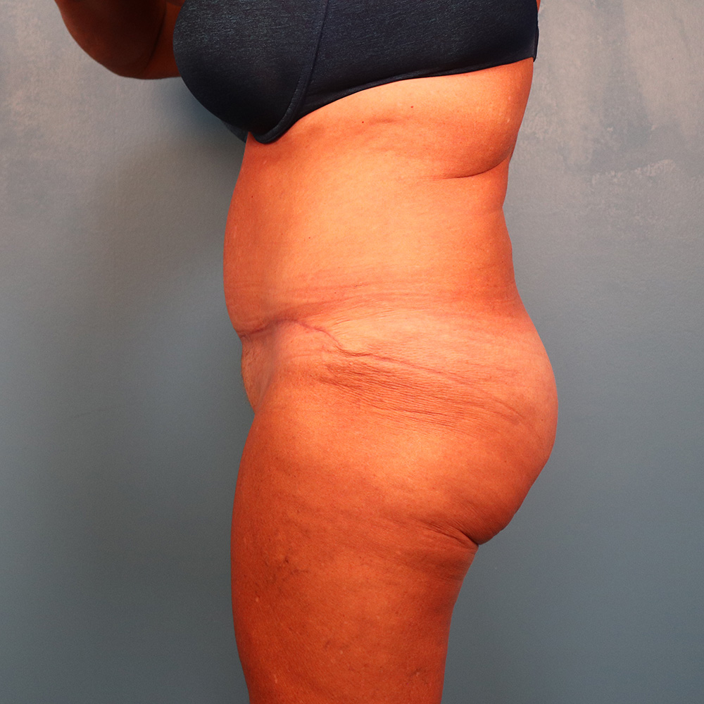 Case--2769 | After Abdominoplasty 2