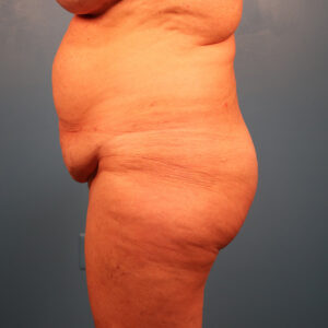 Case--36352 | Before Tummy Tuck (Abdominoplasty) 2