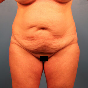 Case--36352 | Before Tummy Tuck (Abdominoplasty) 1