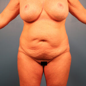 Case--2769 | Before Abdominoplasty 1