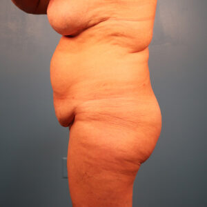 Case--2769 | Before Abdominoplasty 2