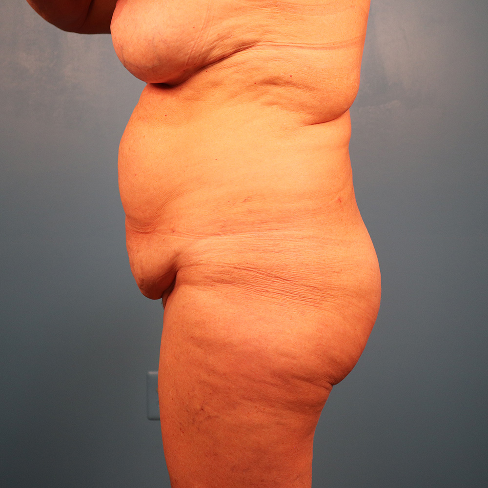 Case--2769 | Before Abdominoplasty 2