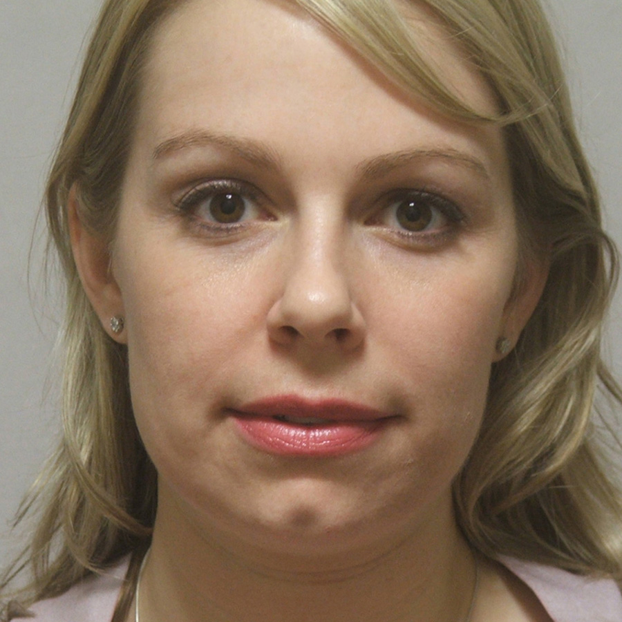 Case--1634 | Before Rhinoplasty