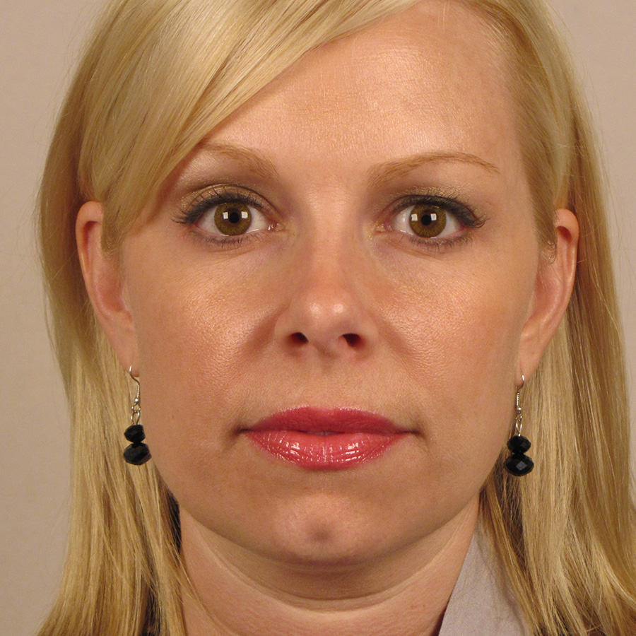 Case--1634 | After Rhinoplasty