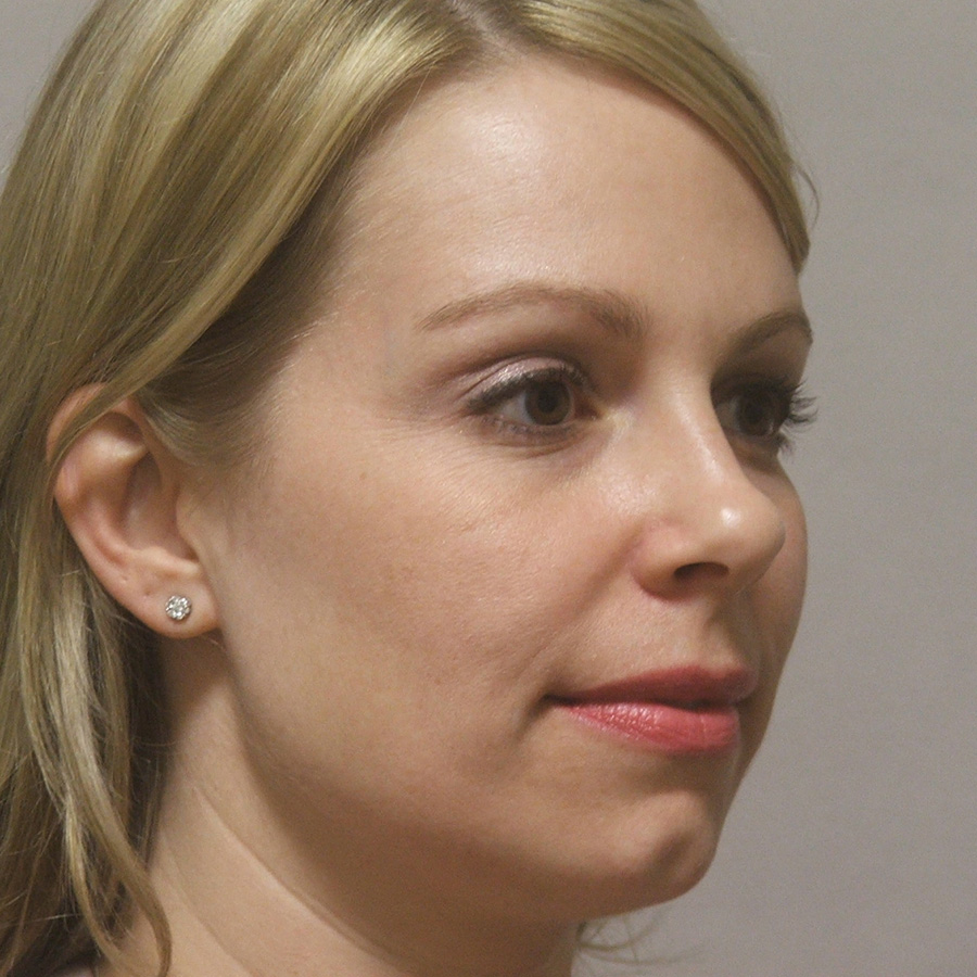 Case--1634 | Before Rhinoplasty 2