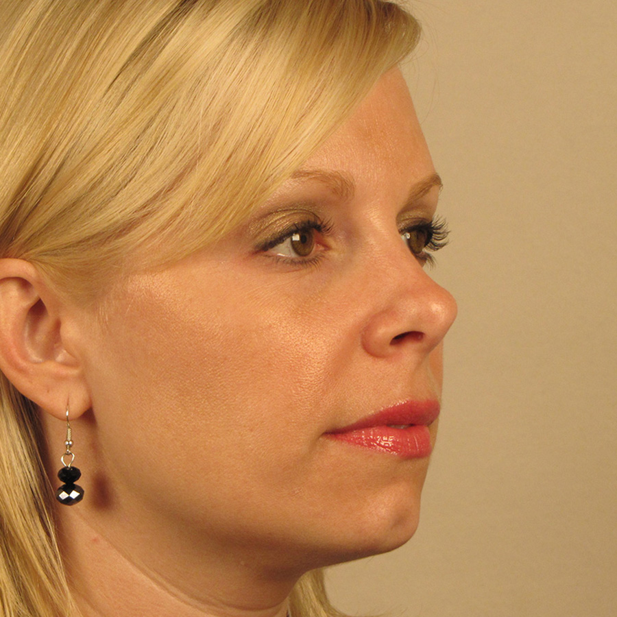 Case--1634 | After Rhinoplasty 2