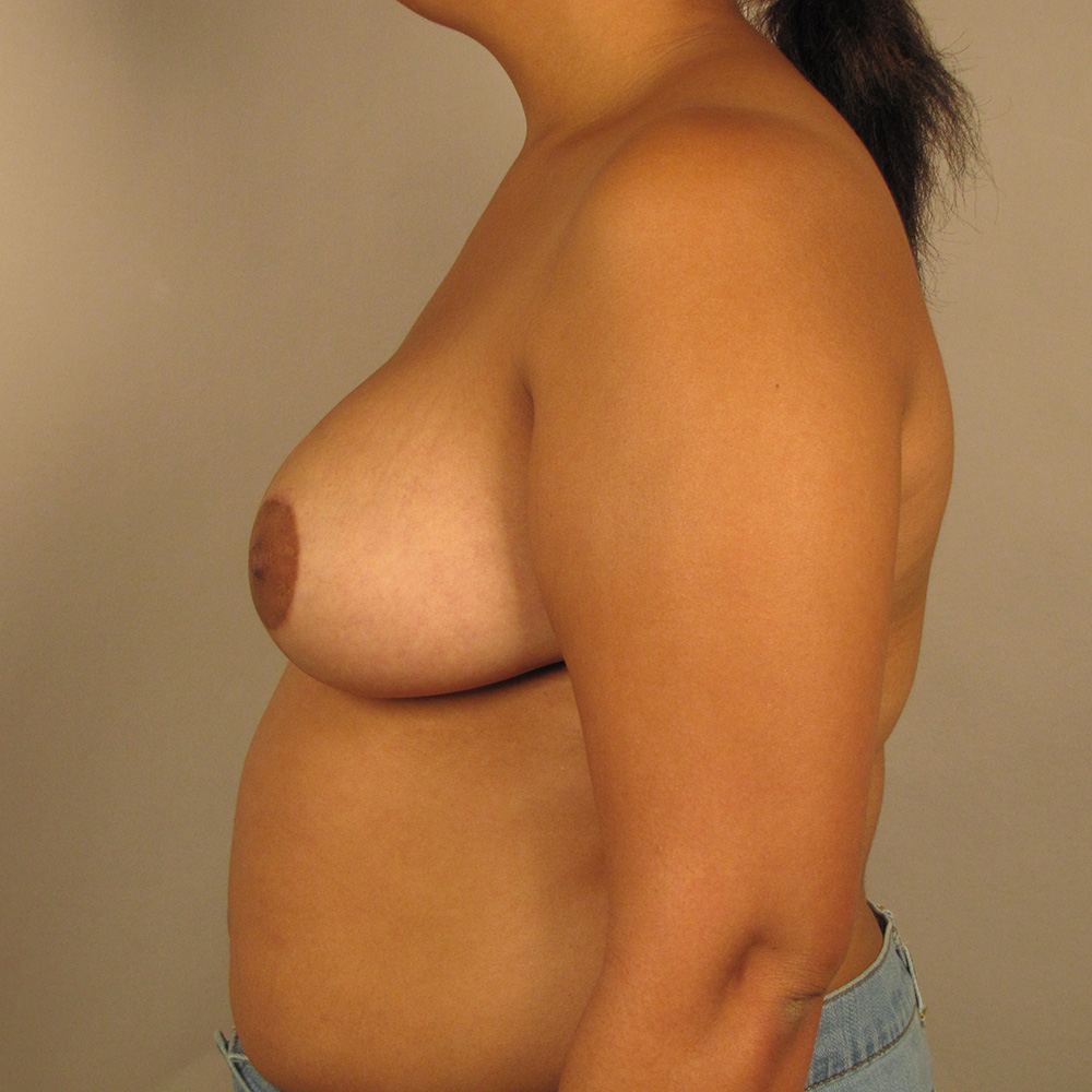 Case--3998 | After Bilateral Reduction Mammaplasty (Breast Reduction) 2
