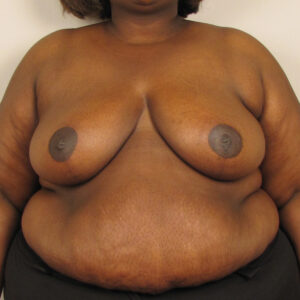 Case--1855 | After Bilateral Reduction Mammaplasty (Breast Reduction) 1