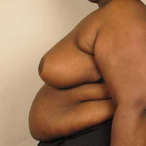 Case--1855 | After Bilateral Reduction Mammaplasty (Breast Reduction) 2