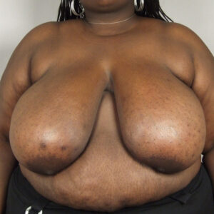 Case--1855 | Before Bilateral Reduction Mammaplasty (Breast Reduction) 1