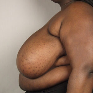 Case--1855 | Before Bilateral Reduction Mammaplasty (Breast Reduction) 2
