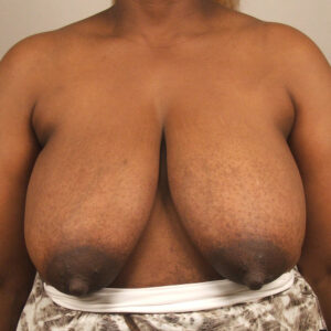 Case--6676 | Before Bilateral Reduction Mammaplasty (Breast Reduction) 1