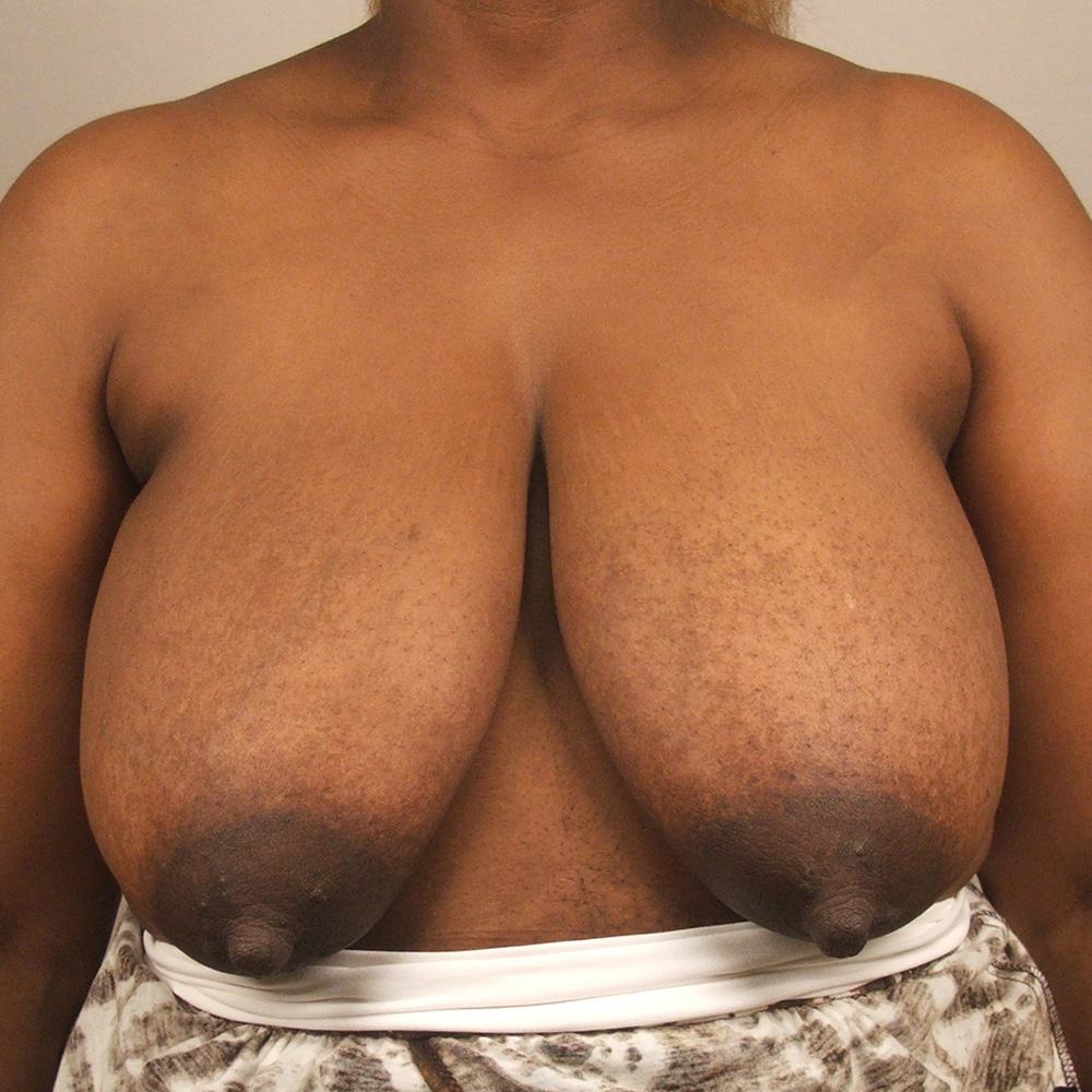 Case--6676 | Before Breast