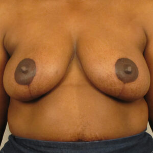Case--6676 | After Bilateral Reduction Mammaplasty (Breast Reduction) 1