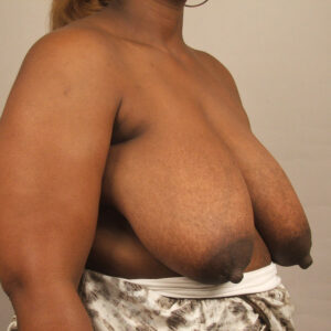 Case--6676 | Before Bilateral Reduction Mammaplasty (Breast Reduction) 2