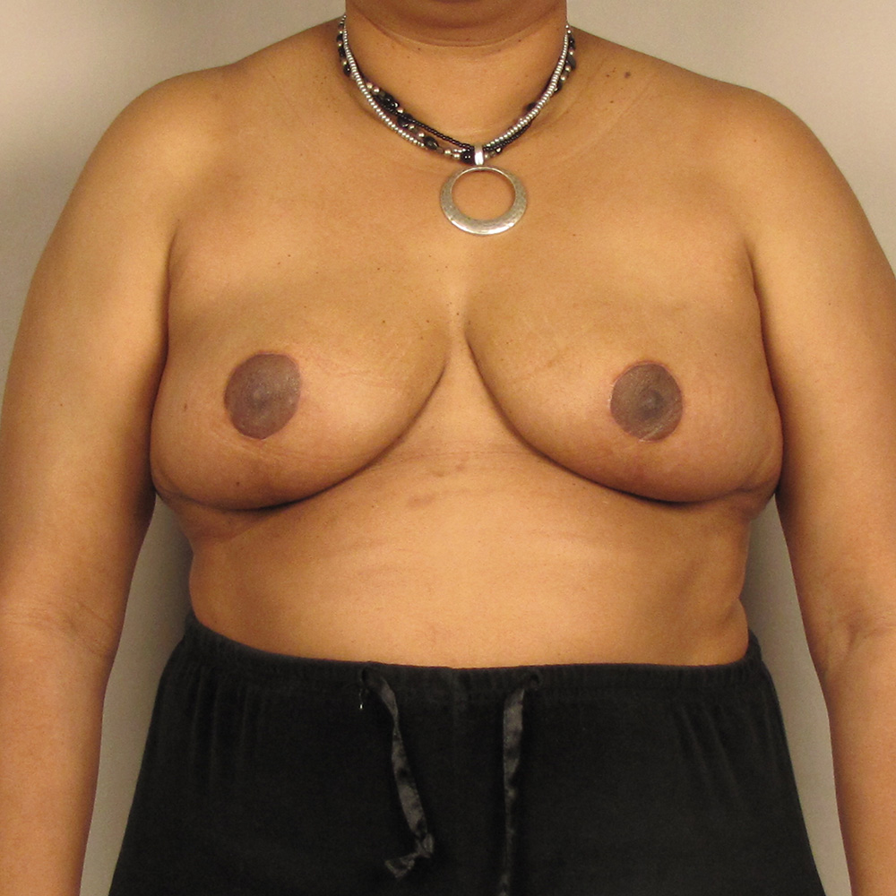 Case--7251 | After Bilateral Reduction Mammaplasty (Breast Reduction)