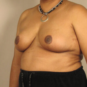 Case--7251 | After Bilateral Reduction Mammaplasty (Breast Reduction) 2
