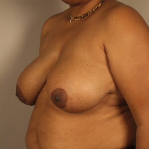Case--7251 | Before Bilateral Reduction Mammaplasty (Breast Reduction) 2