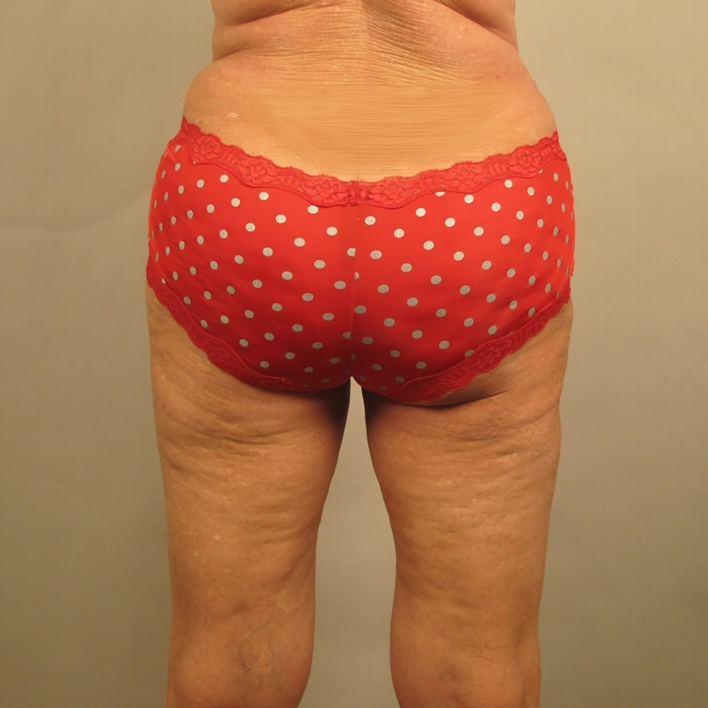 Case--7102 | After Liposuction