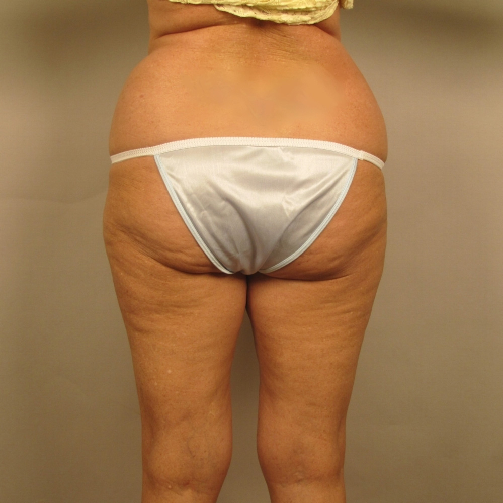 Case--7102 | Before Liposuction