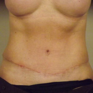 Case--3096 | After Abdominoplasty 1