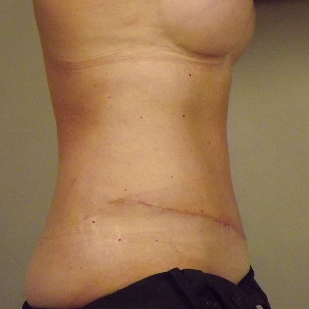 Case--3096 | After Abdominoplasty 2