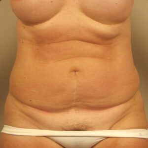 Case--3096 | Before Abdominoplasty 1