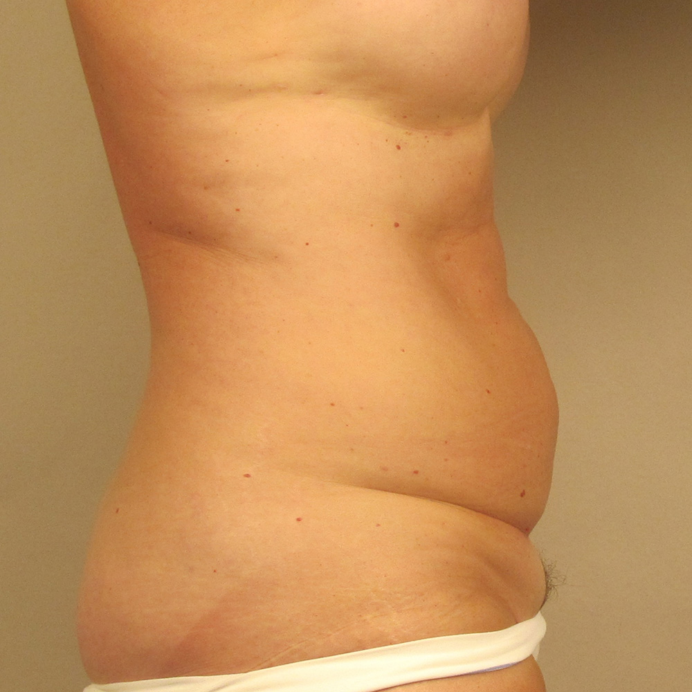 Case--3096 | Before Abdominoplasty 2